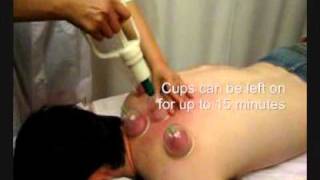 Chinese Remedial Massage - Cupping to Remove Toxins